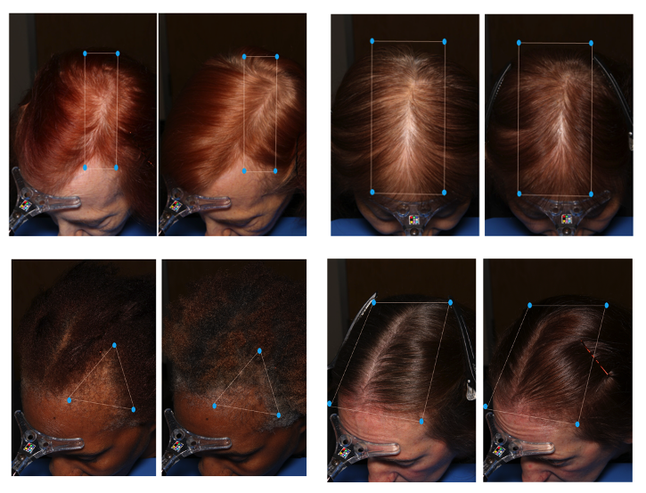 Woman with healthy hair considering collagen supplements